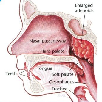 Adenoids treatment in kphb