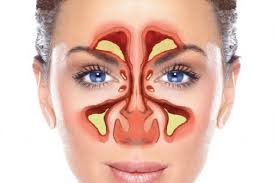 sinusitis Treatment in kphb