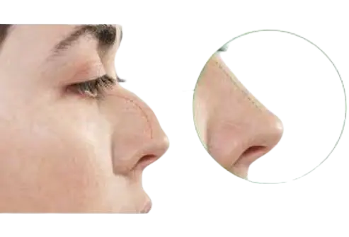 rhinoplasty treatment in hphb