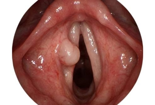 Vocal cord polyps treatment in kphb