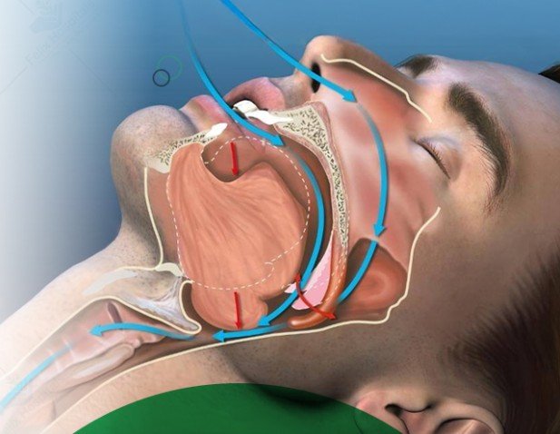 Sleep Apnea Treatment in KPHB